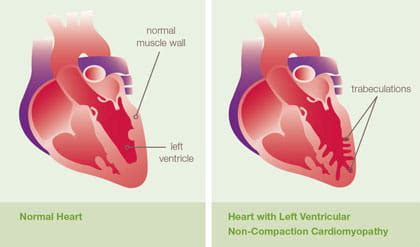 non compaction lv|symptoms of lv noncompaction.